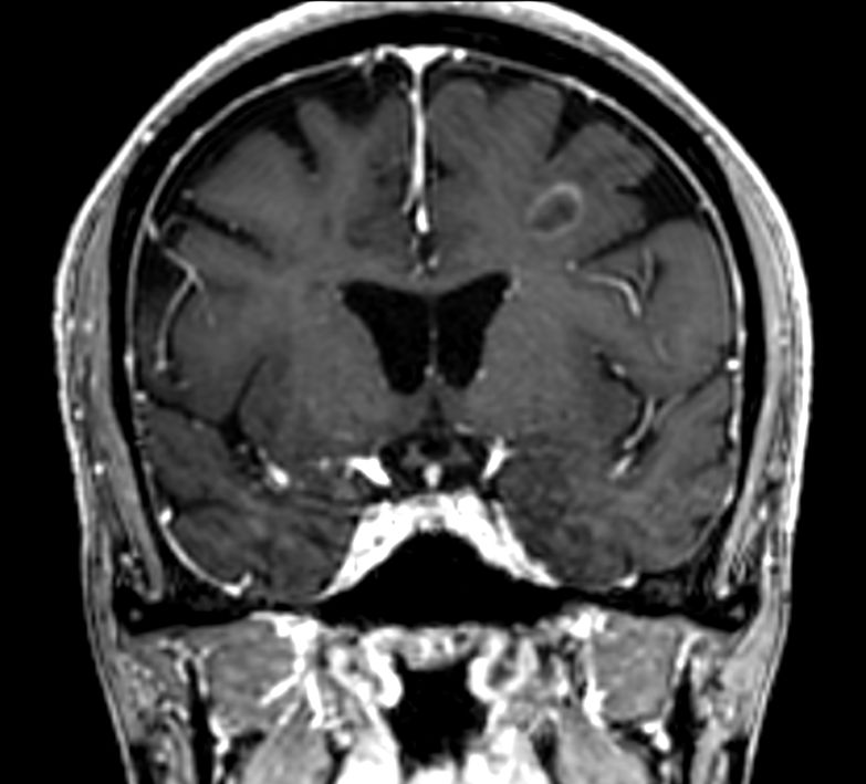 3D T1w FFE (reformat) +Gado <b>Compressed SENSE</b>