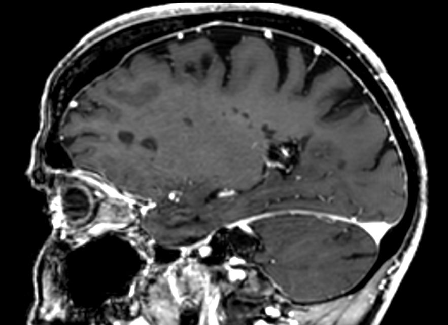 3D T1w FFE (reformat) +Gado <b>Compressed SENSE</b>