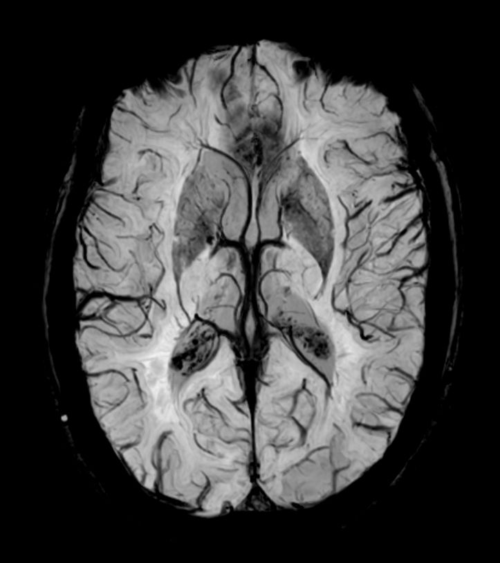 SWIp 6 echoes (minIP)