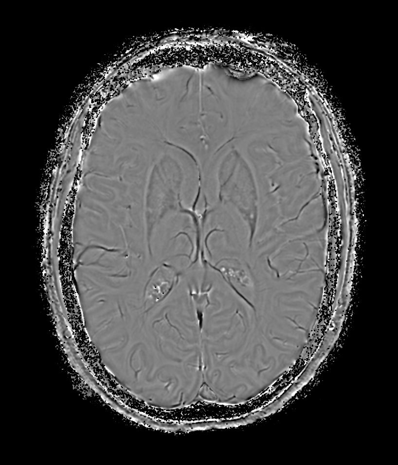 SWIp 6 echoes (Phase)