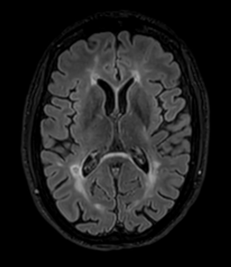 3D T2w FLAIR BrainVIEW <b>Compressed SENSE</b>