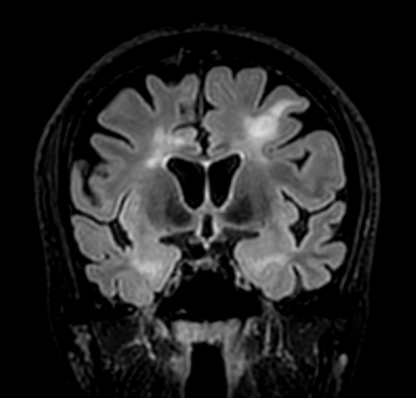 3D T2w FLAIR BrainVIEW (reformat) <b>Compressed SENSE</b>