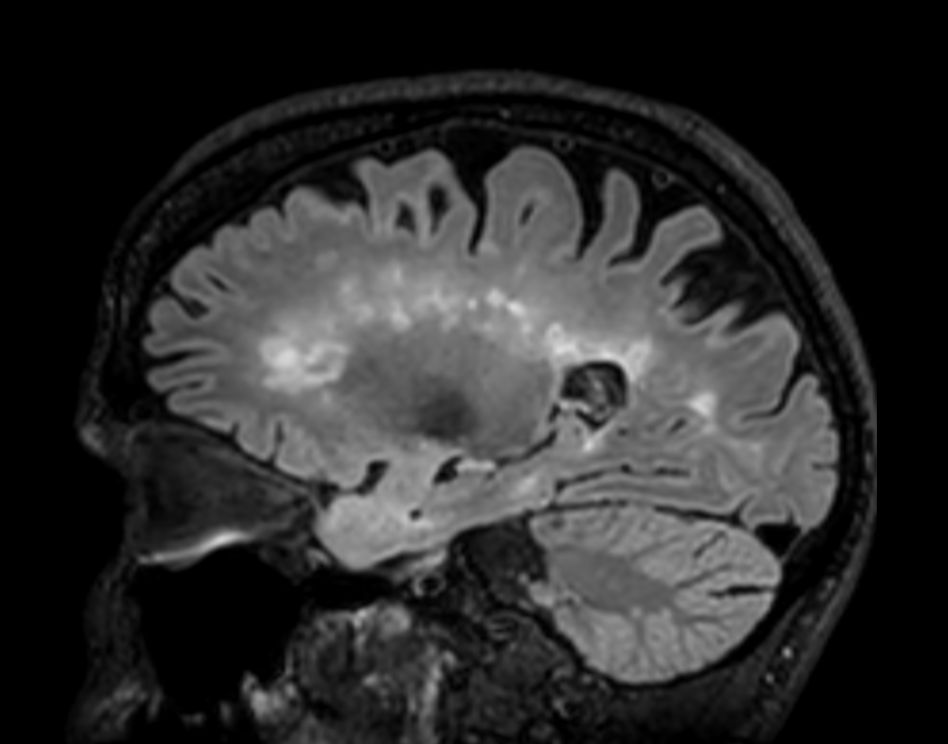 3D T2w FLAIR BrainVIEW (reformat) <b>Compressed SENSE</b>