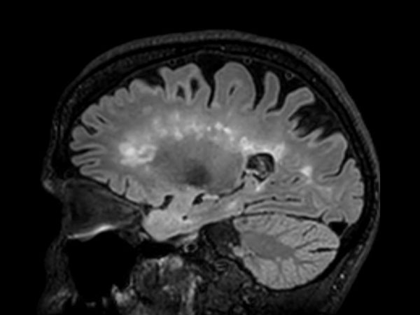 3D T2w FLAIR BrainVIEW (reformat) <b>Compressed SENSE</b>