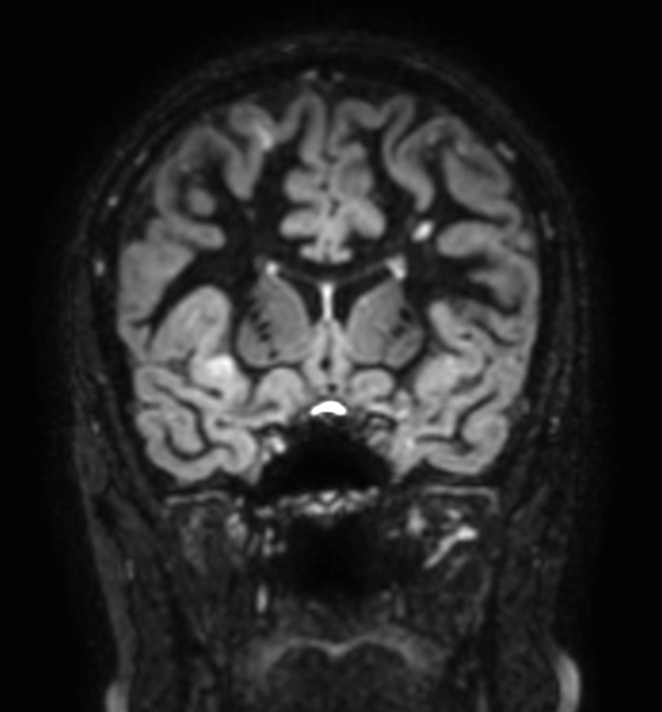 3D Double IR (reformat)