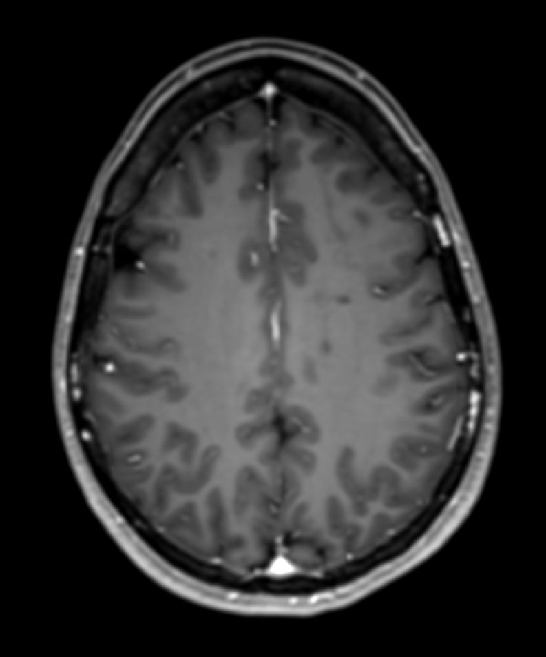 3D T1w FFE +Gado (reformat)