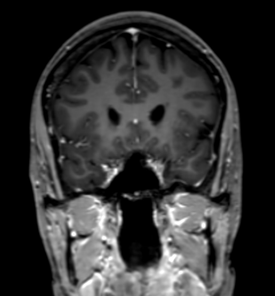 3D T1w FFE +Gado (reformat)