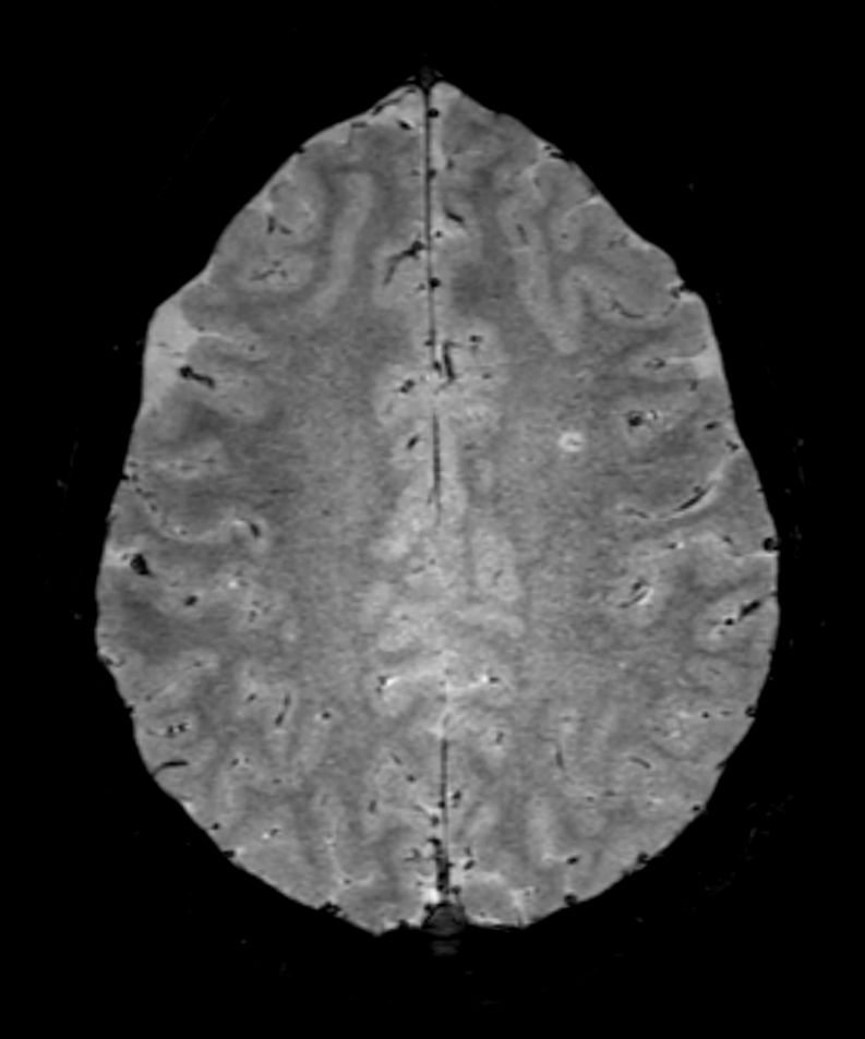 3D SWI EPI (reformat)