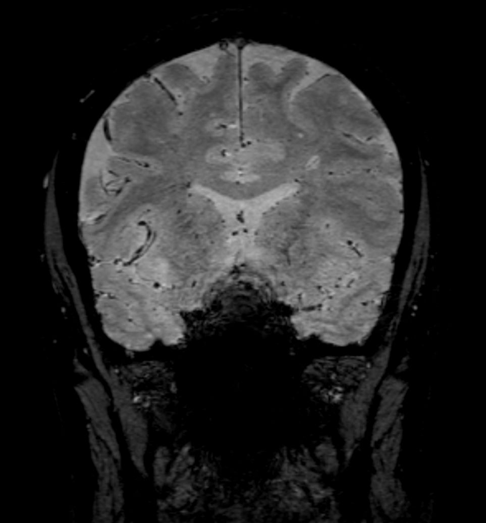 3D SWI EPI (reformat)