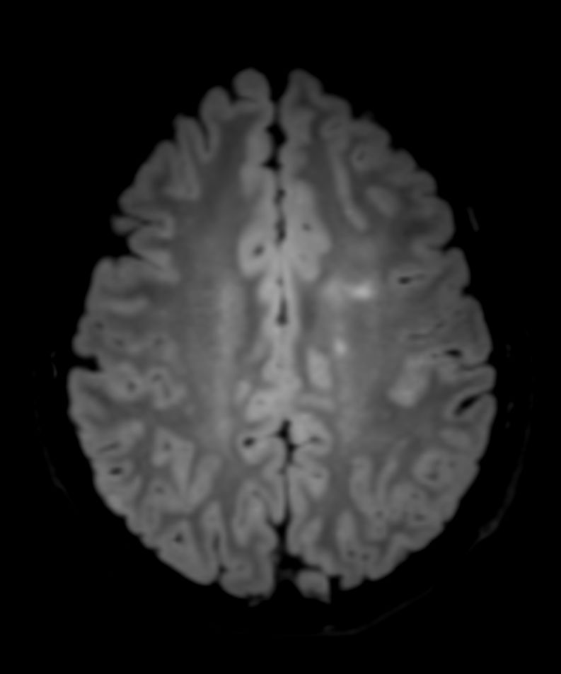 3D T2w FLAIR (reformat)