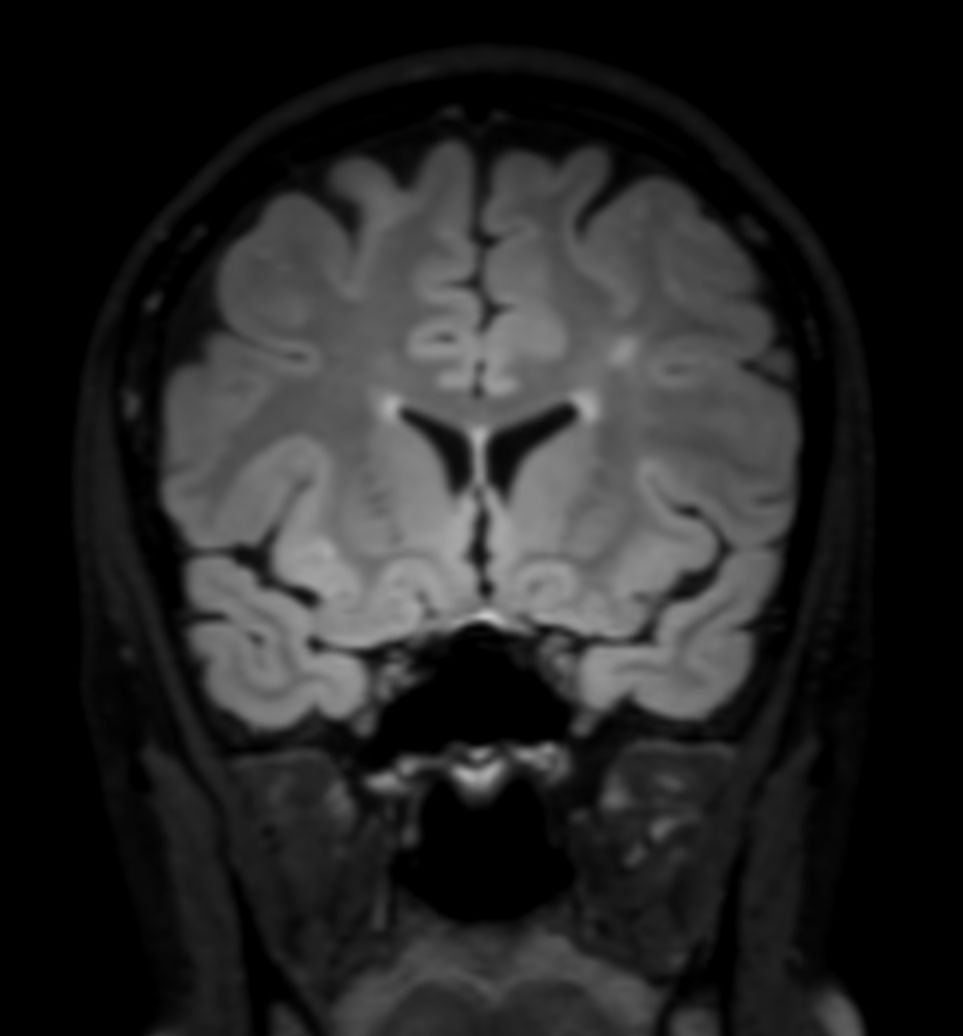 3D T2w FLAIR (reformat)