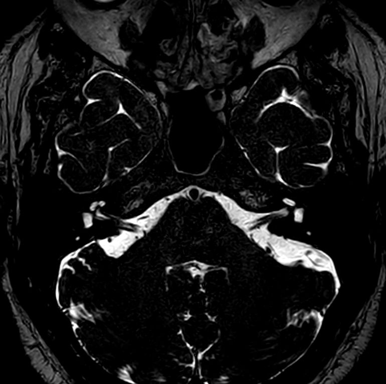 IAC - T2w TSE 3D DRIVE <b>Compressed SENSE</b>