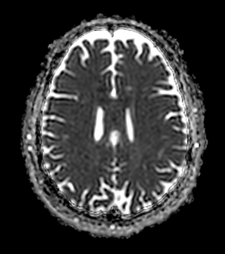Diffusion b1000 (ADC)