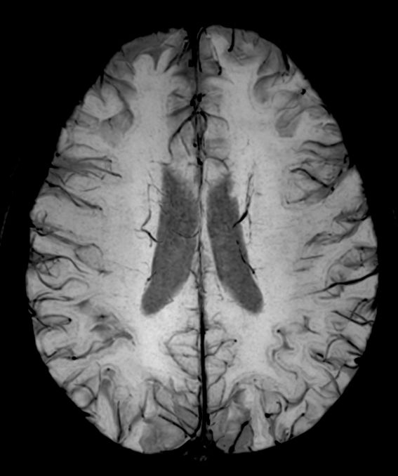SWIp (minIP) <b>Compressed SENSE</b>