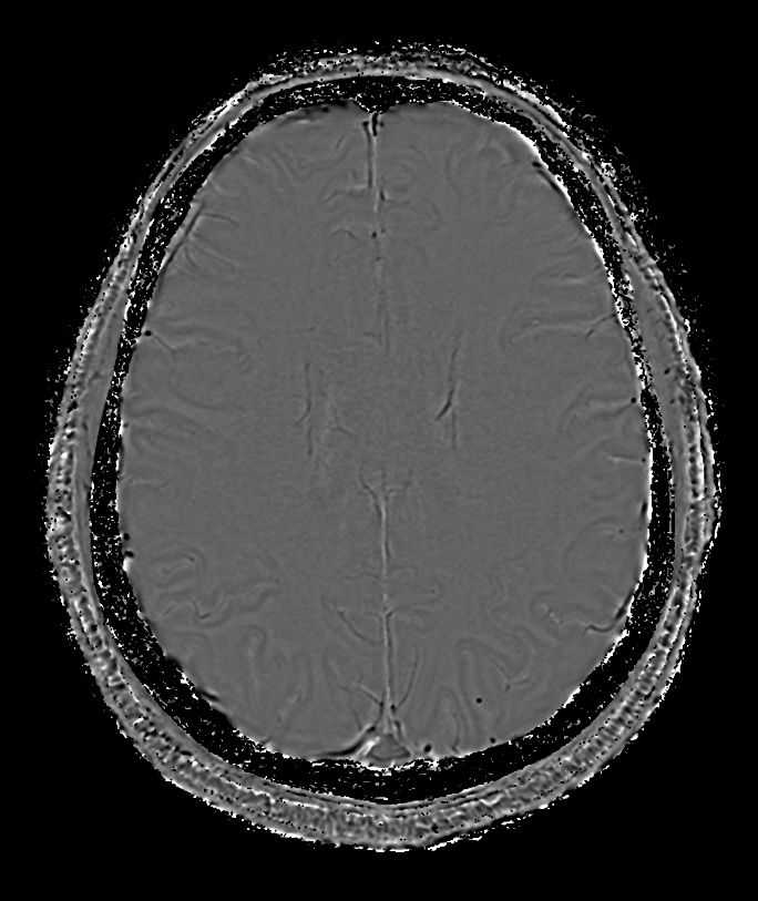 SWIp (Phase) <b>Compressed SENSE</b>