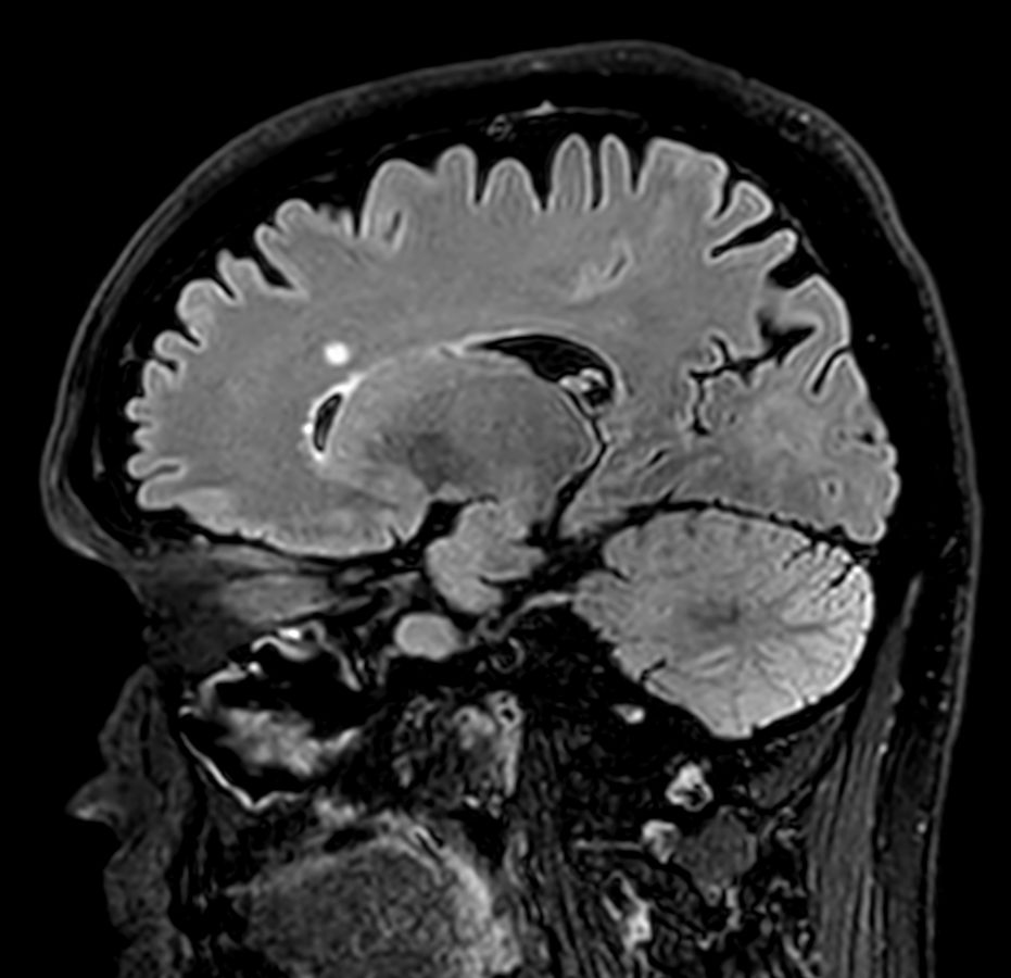 3D T2w FLAIR <b>Compressed SENSE</b>