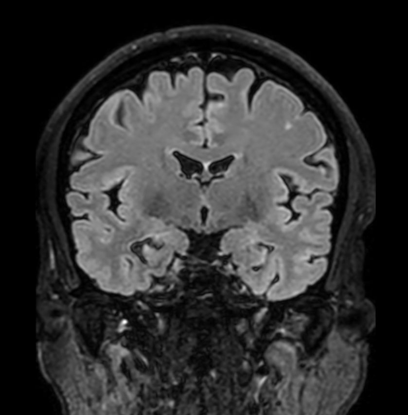 3D T2w FLAIR (Reformat) <b>Compressed SENSE</b>