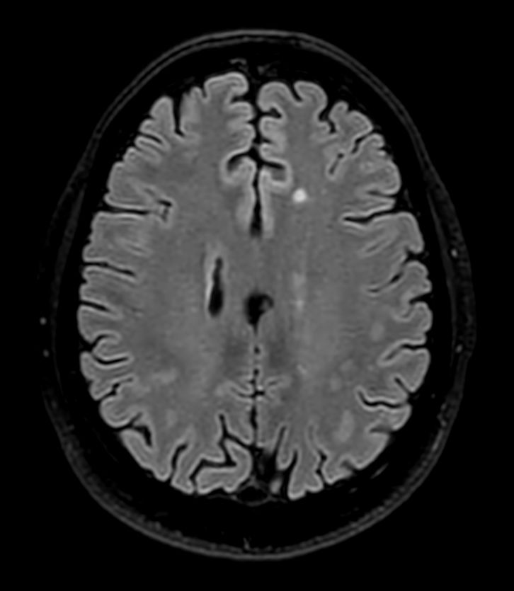 3D T1w Black Blood (+gado) (Reformat) <b>Compressed SENSE</b>