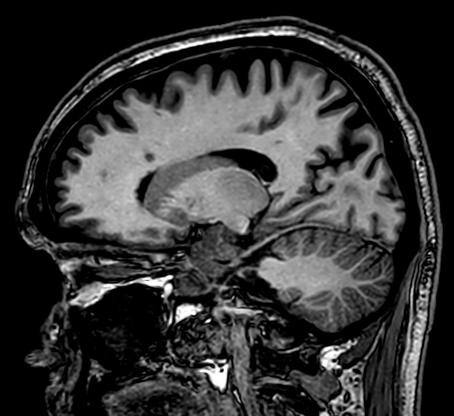 3D T1w FFE <b>Compressed SENSE</b>