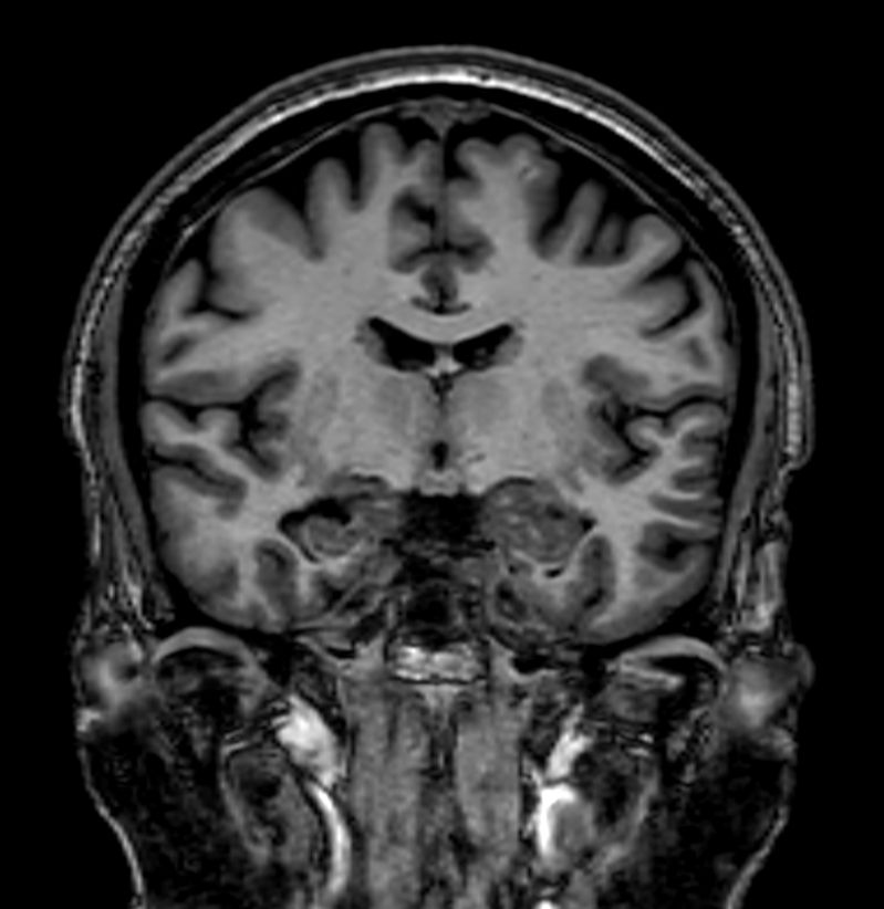 3D T1w FFE (Reformat) <b>Compressed SENSE</b>