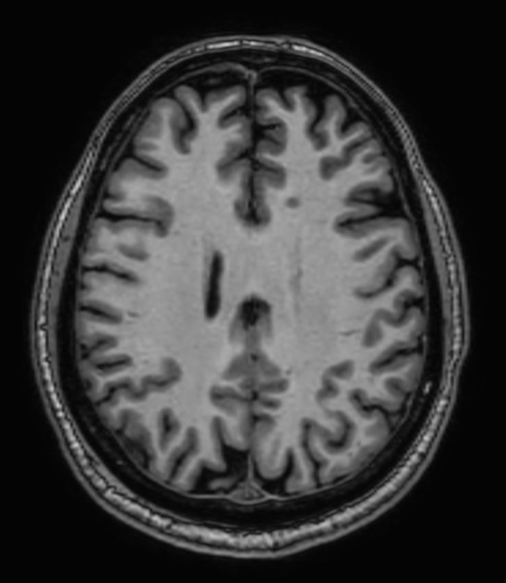 3D T1w FFE (Reformat) <b>Compressed SENSE</b>