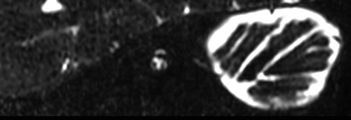 IAC - T2w TSE 3D DRIVE (Right oblique reformat) <b>Compressed SENSE</b>