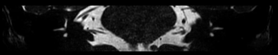 IAC - T2w TSE 3D DRIVE <b>Compressed SENSE</b>