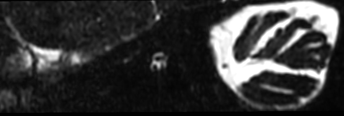 IAC - T2w TSE 3D DRIVE (Left oblique reformat) <b>Compressed SENSE</b>