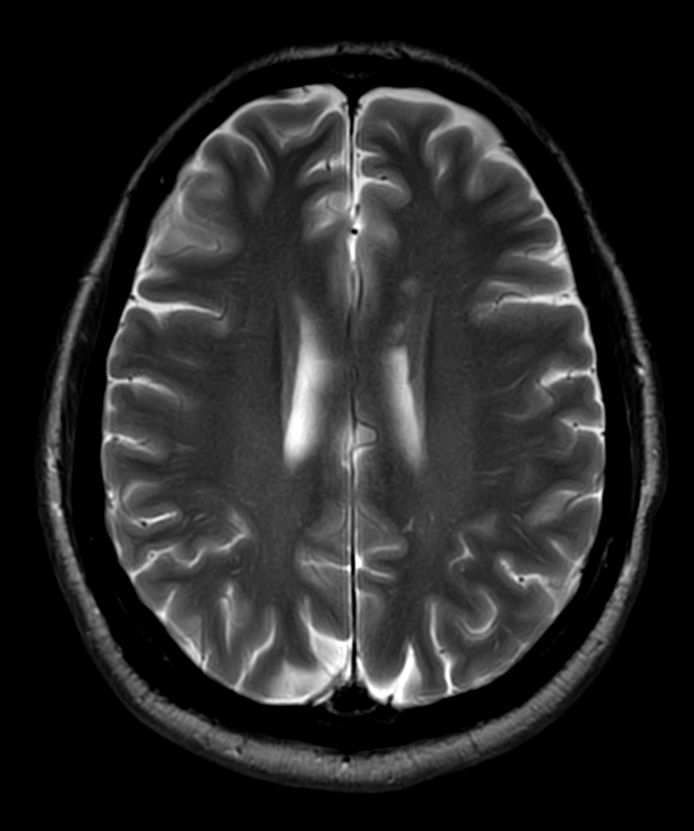 T2w TSE MultiVane XD