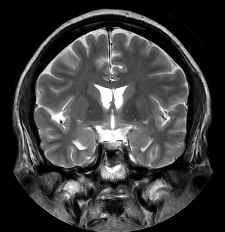 T2w TSE MultiVane XD