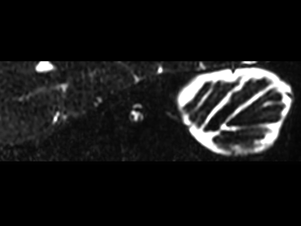 IAC - T2w TSE 3D DRIVE (Right oblique reformat) <b>Compressed SENSE</b>