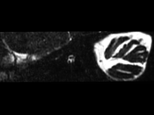 IAC - T2w TSE 3D DRIVE (Left oblique reformat) <b>Compressed SENSE</b>