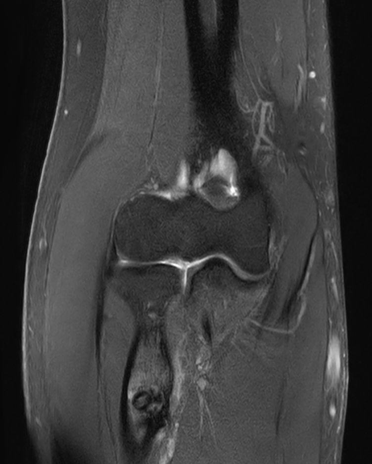PDw TSE FatSat <b>Compressed SENSE</b>