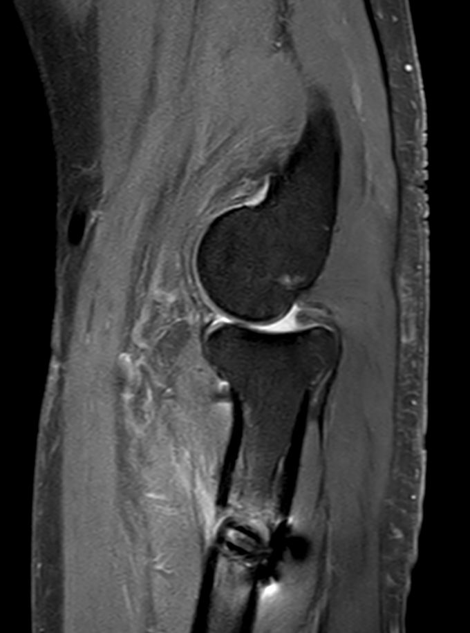 PDw TSE FatSat <b>Compressed SENSE</b>