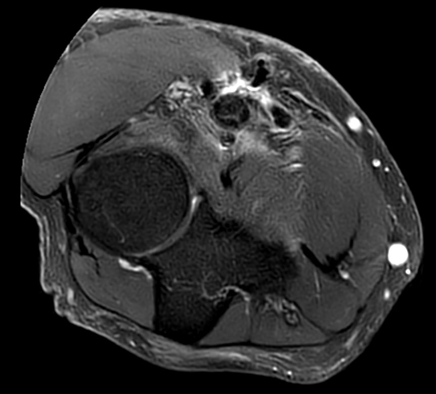 T2w TSE MultiVane XD FatSat