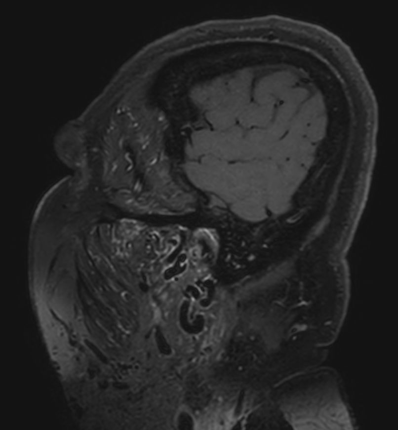 3D T1w Black Blood (+gado) <b>Compressed SENSE</b>