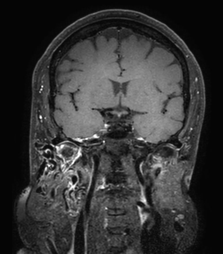 3D T1w Black Blood (+gado) (Reformat) <b>Compressed SENSE</b>