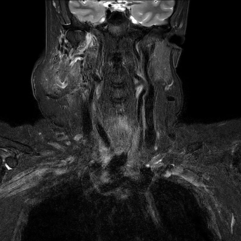 T2w SPAIR <b>Compressed SENSE</b>