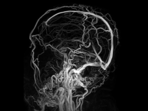 MR Venogram (+gado) <b>Compressed SENSE</b>