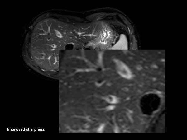 Axial T2w SPAIR SENSE = 4 in RL direction