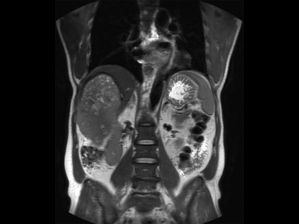 Coronal T2w TSE