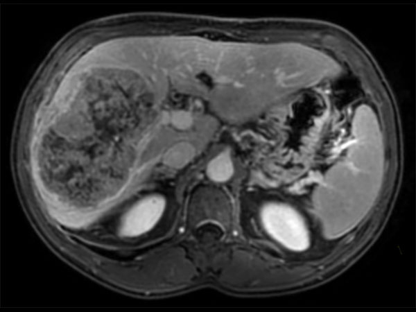 Axial  dynamic mDIXON (post-gado)