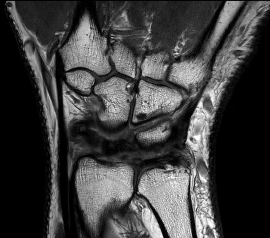 PDw TSE <b>Compressed SENSE</b>