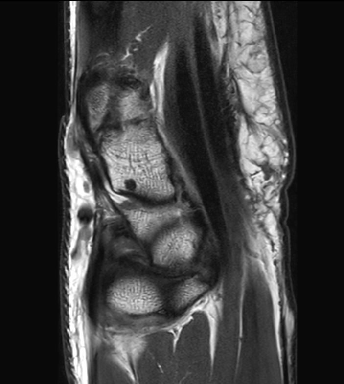 PDw TSE <b>Compressed SENSE</b>