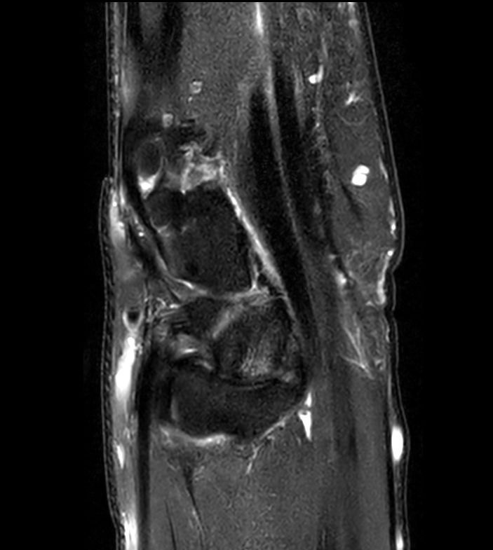 T2w TSE FatSat <b>Compressed SENSE</b>