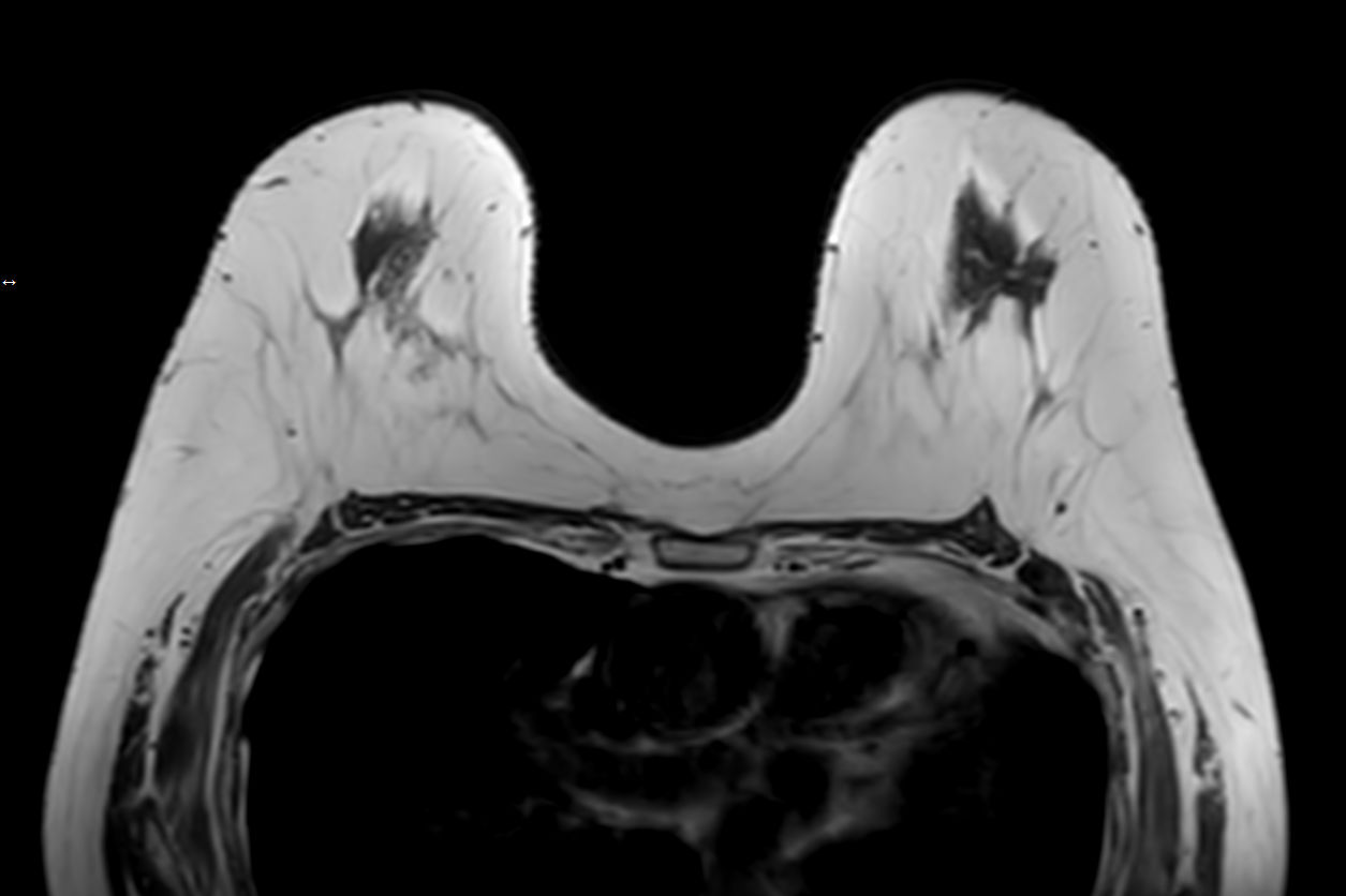 T1w TSE<b>Compressed SENSE</b>