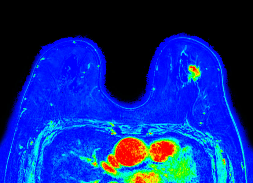 Dynamic 3D mDIXON XD (are under curve) <b>Compressed SENSE</b>