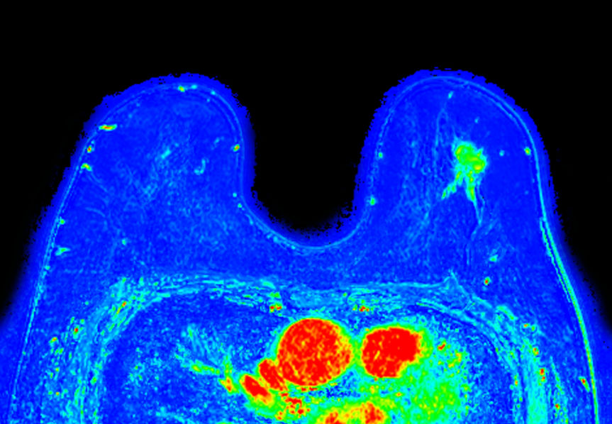 Dynamic 3D mDIXON XD (washin) <b>Compressed SENSE</b>