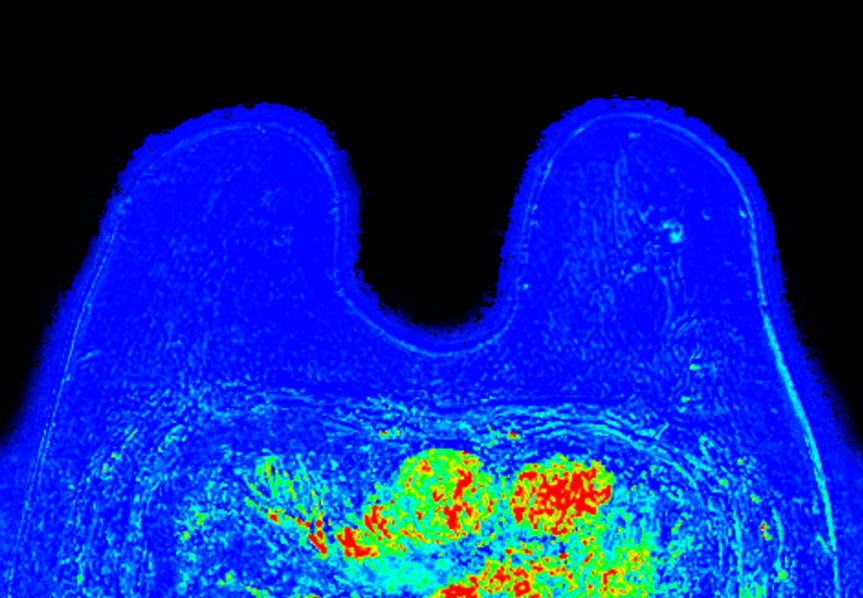 Dynamic 3D mDIXON XD (washout) <b>Compressed SENSE</b>