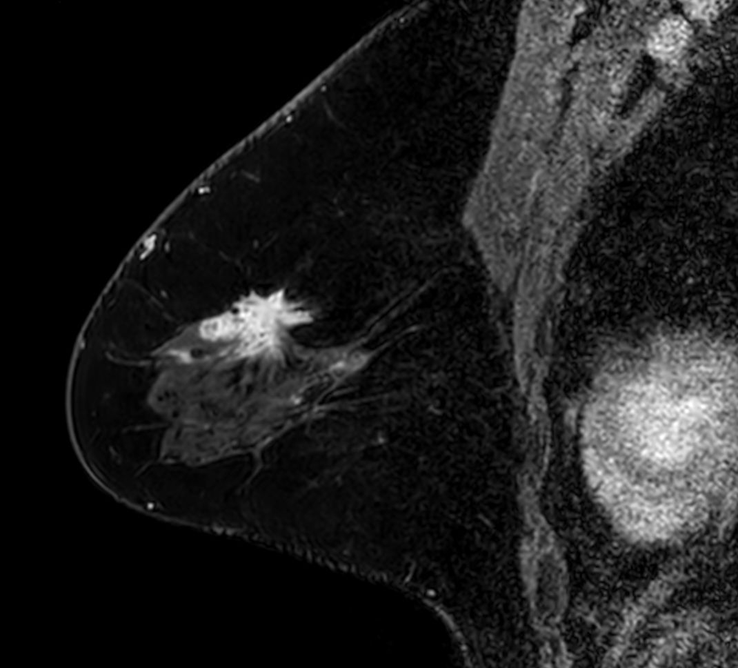 3D mDIXON XD +gado (right breast) <b>Compressed SENSE</b>